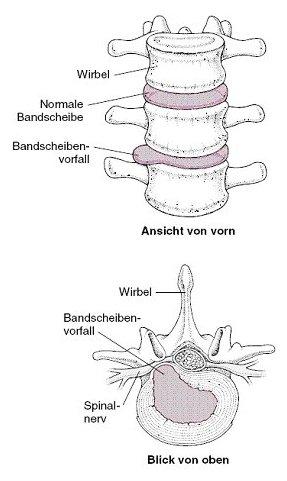 Bandscheibe