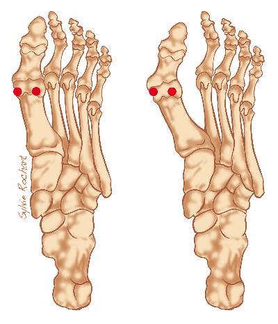 Hallux valgus